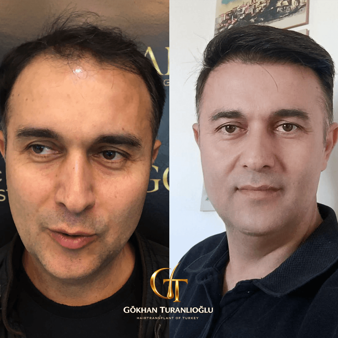 Saç ekimi öncesi ve sonrası — sonuç 8